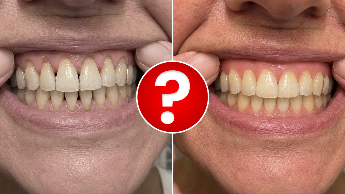 Can Receding Gums Really Grow Back? A Cleveland MD Says Yes, And It Comes Down To THIS One Thing Dentists Overlook